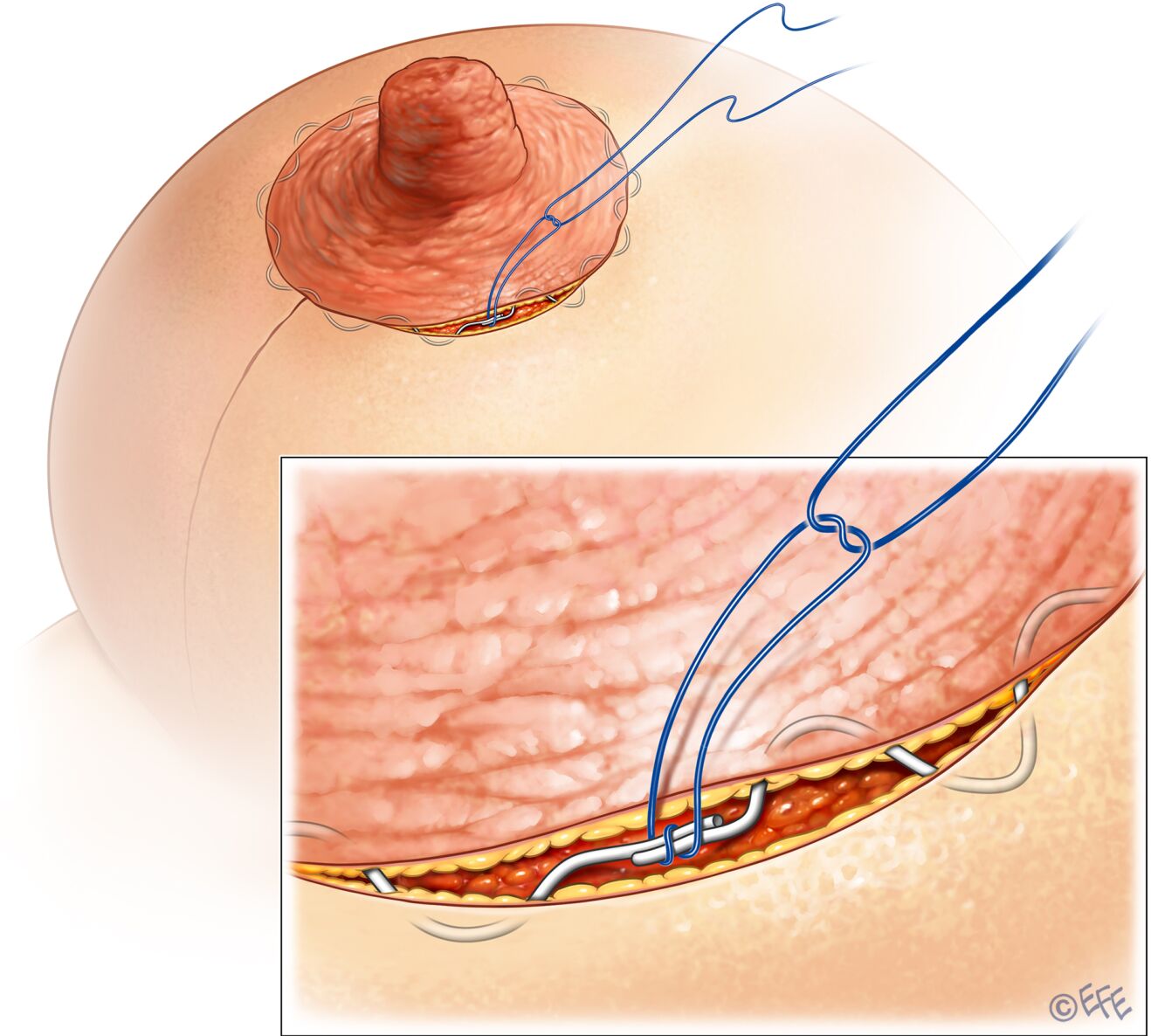 Size of post-pregnancy areolas can be adjusted with surgery